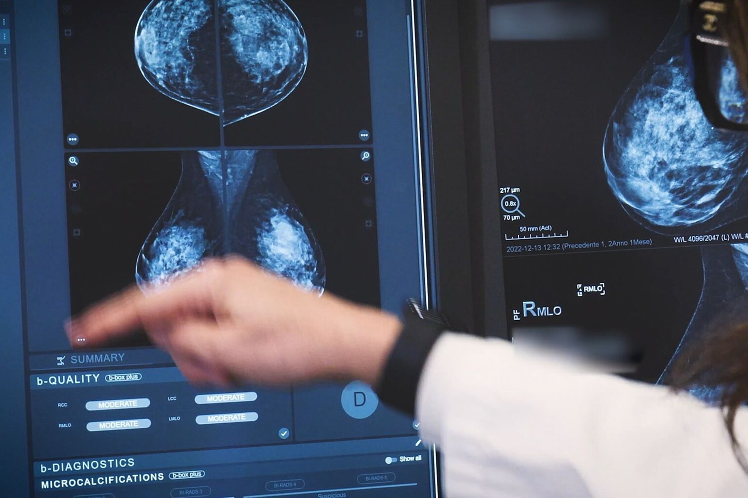 Tumori al seno, all'Humanitas diagnosi precoce grazie all'IA