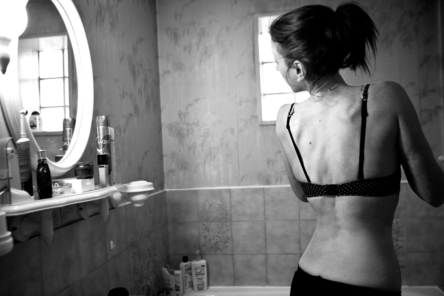 L'anoressia nervosa colpisce in Italia 540mila le donne, luce sui marcatori