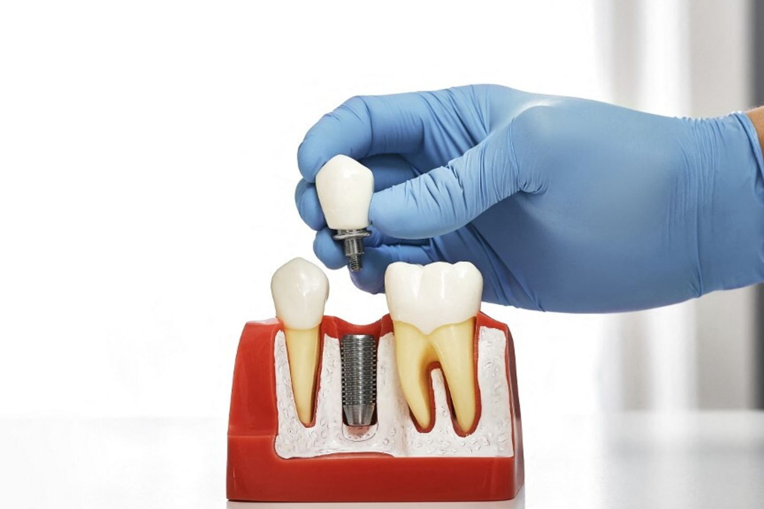 Impianto dentale