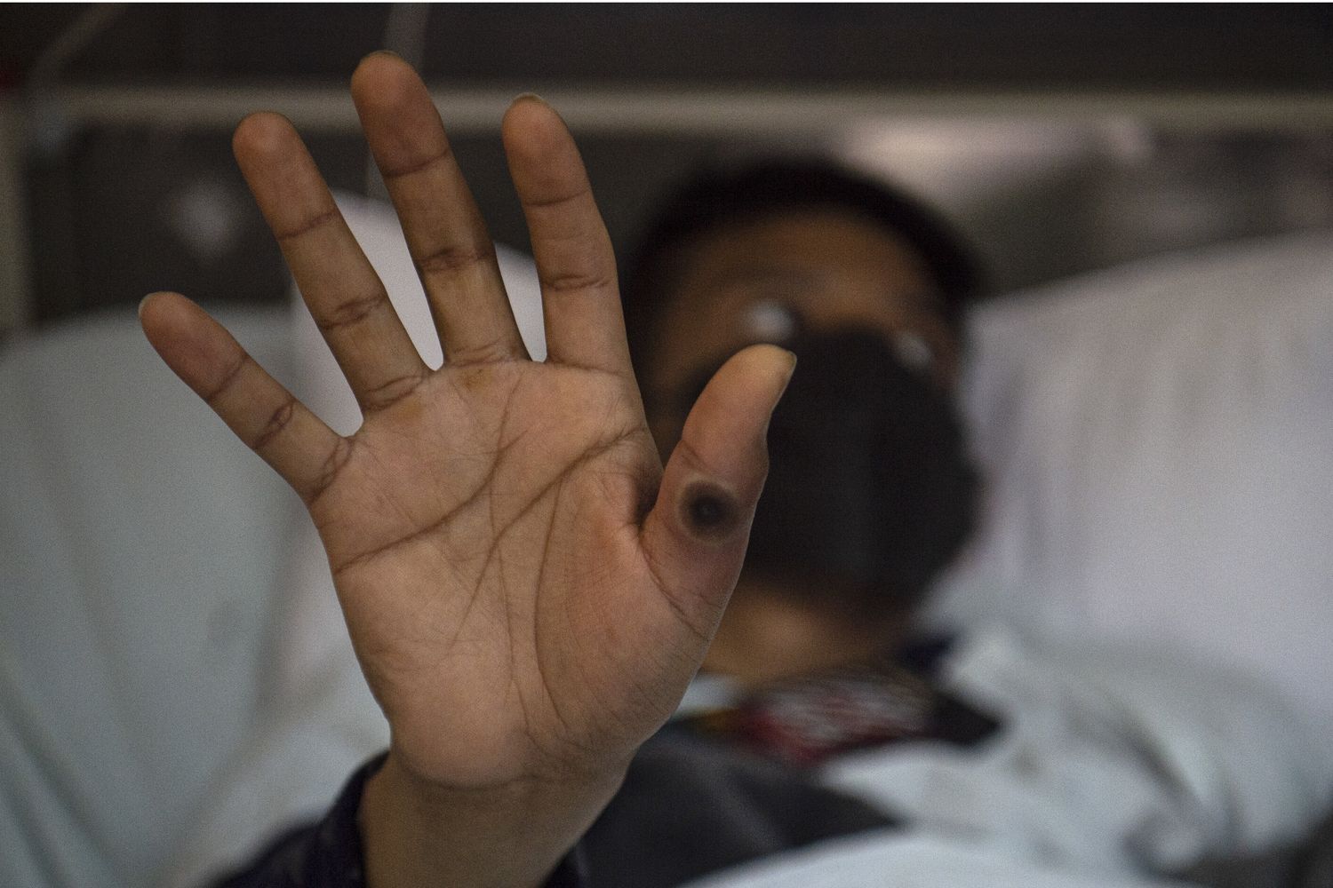 Vaiolo delle scimmie