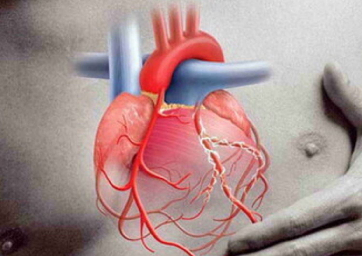 Infarto