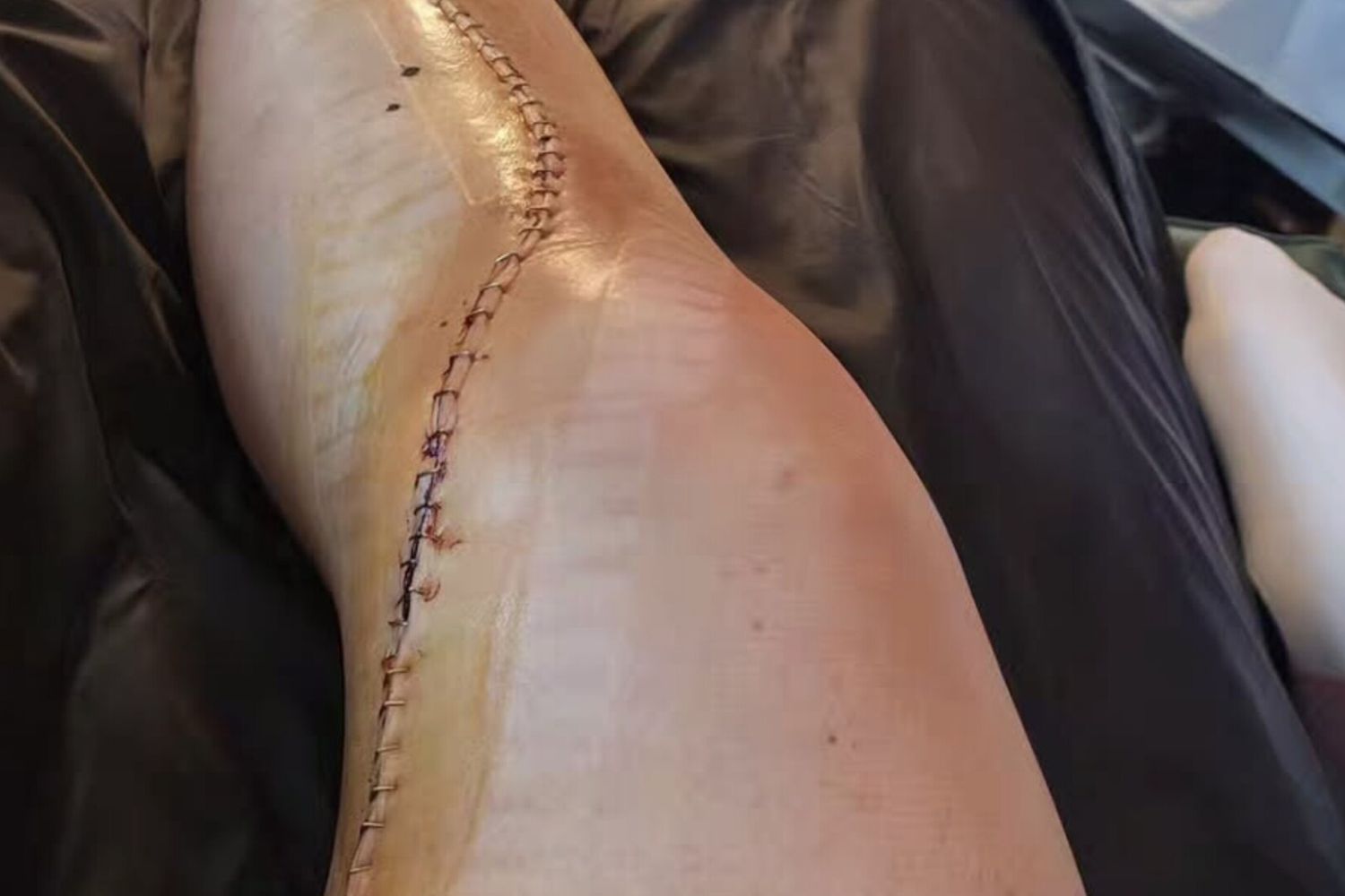 Brignone, cicatrice operazione