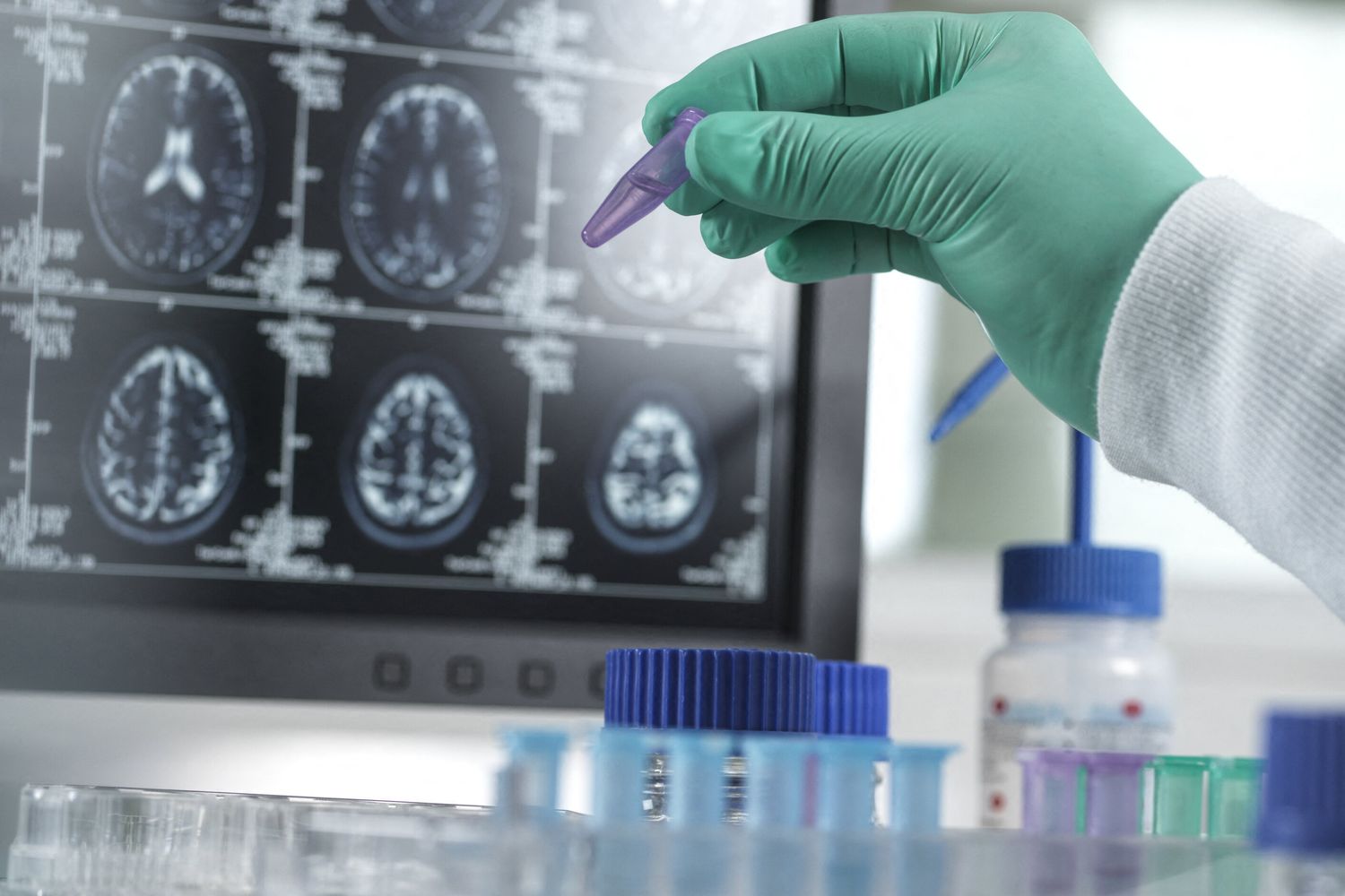 Demenza, studi sul comportamento del cervello