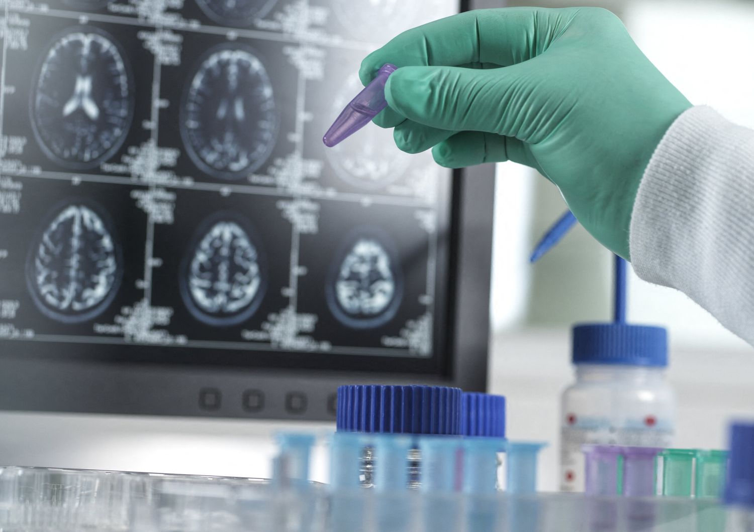 Demenza, studi sul comportamento del cervello