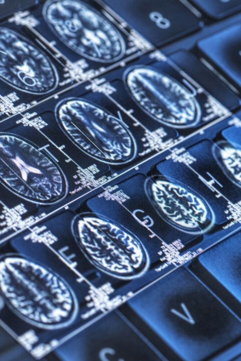 Alzheimer
