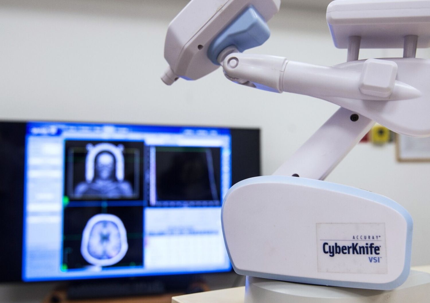 cyberknife radioterapia tumori