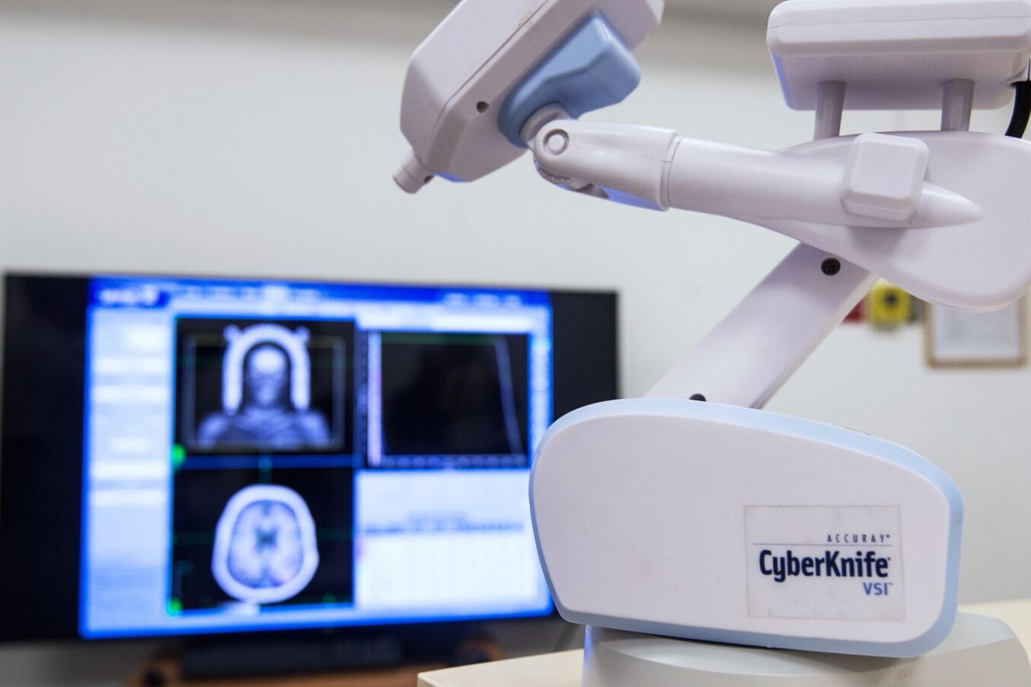 cyberknife radioterapia tumori