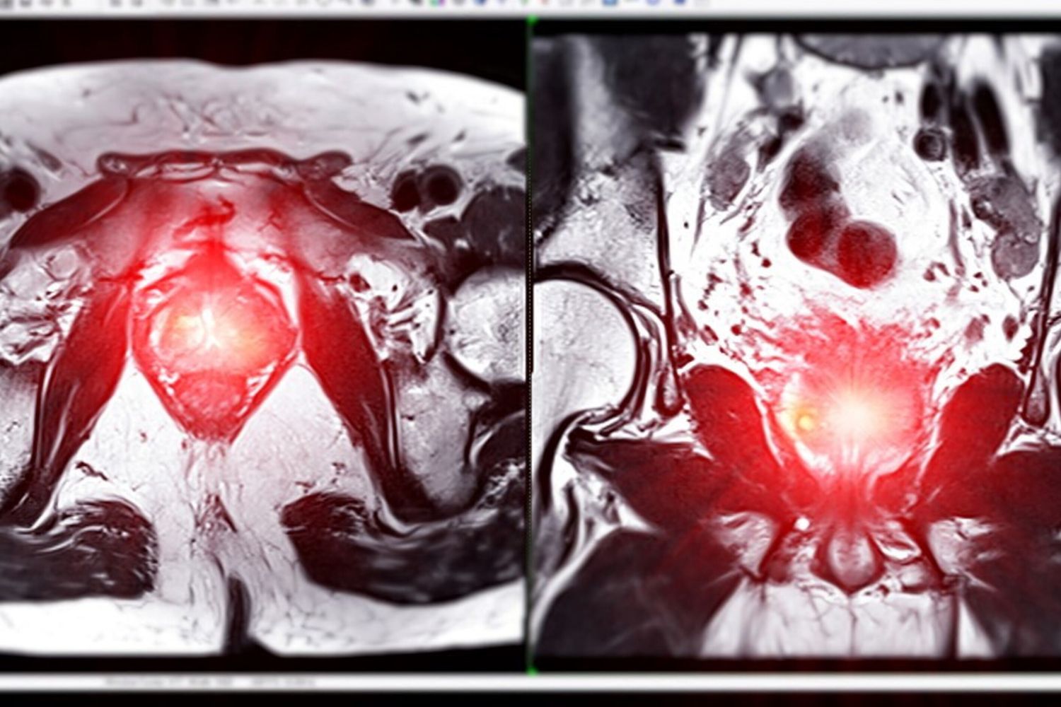 Cancro alla prostata