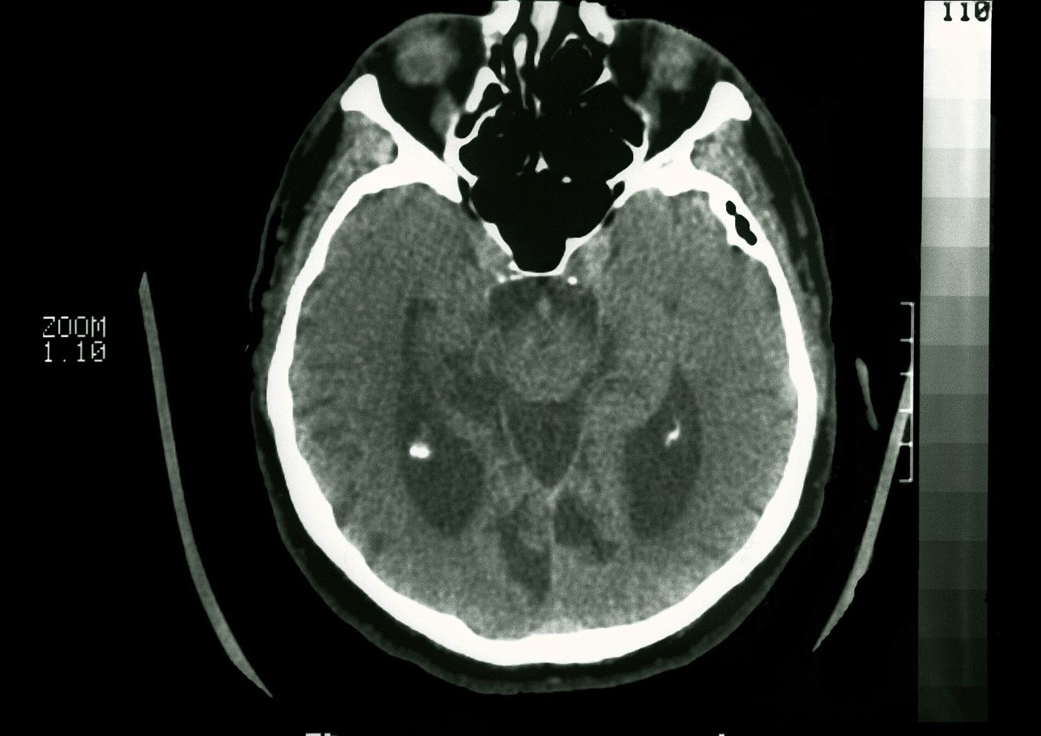 Una tac del cervello evidenzia i segni di&nbsp;Alzheimer