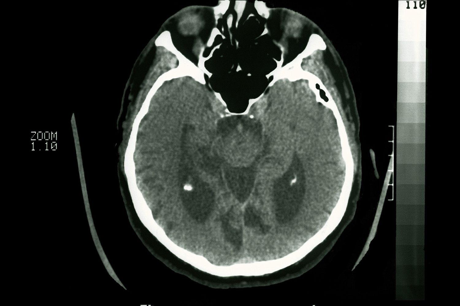 Una tac del cervello evidenzia i segni di&nbsp;Alzheimer