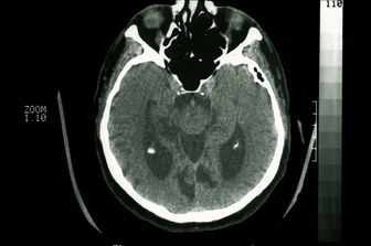 Una tac del cervello evidenzia i segni di&nbsp;Alzheimer