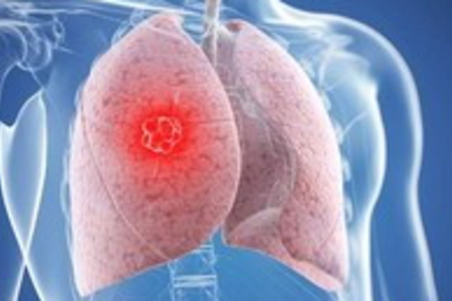 Tumore polmone