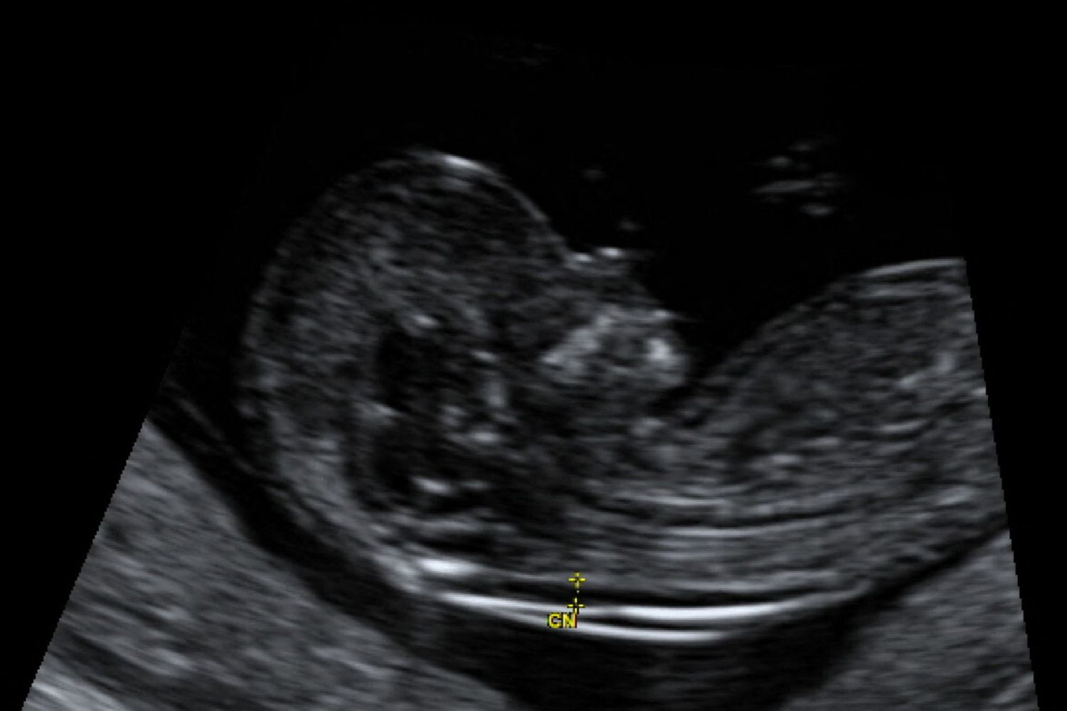 analisi del feto&nbsp;