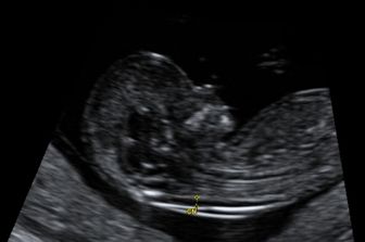 analisi del feto&nbsp;