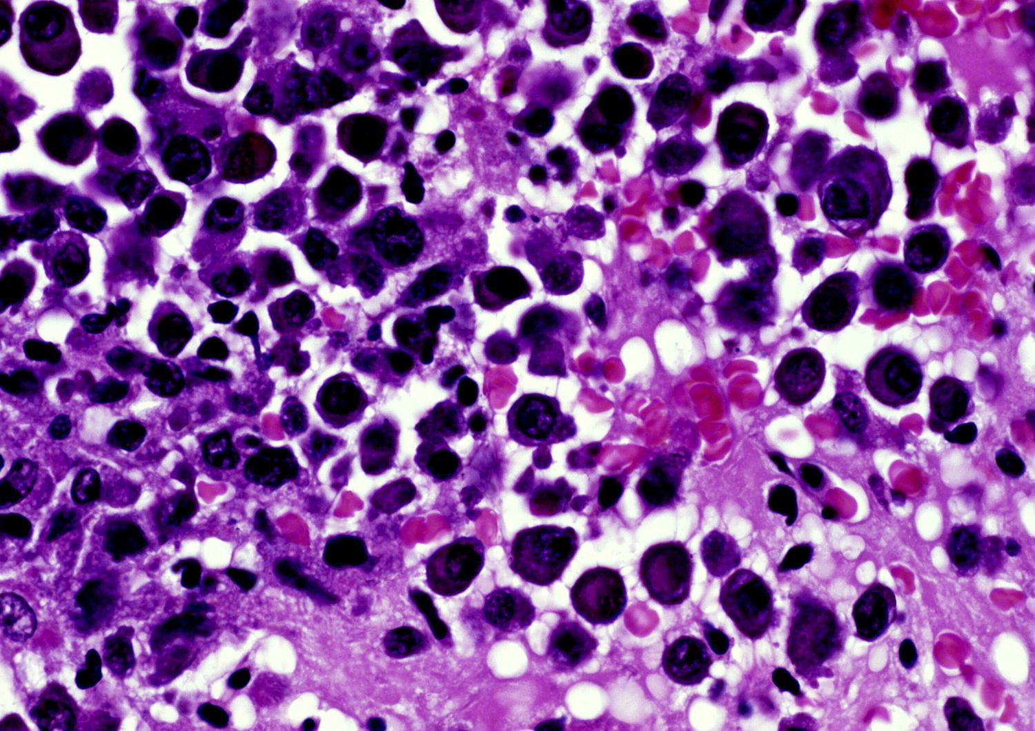 mieloma multiplo tris farmaci triplica sopravvivenza