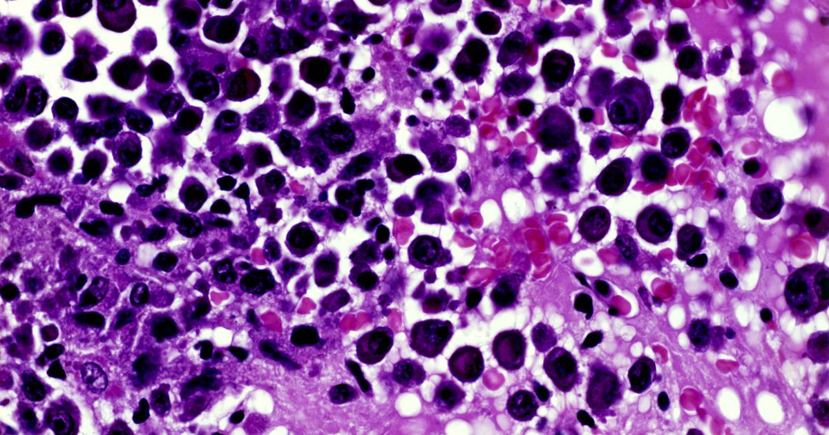 多発性骨髄腫、薬物のトリプル生存のトリオ