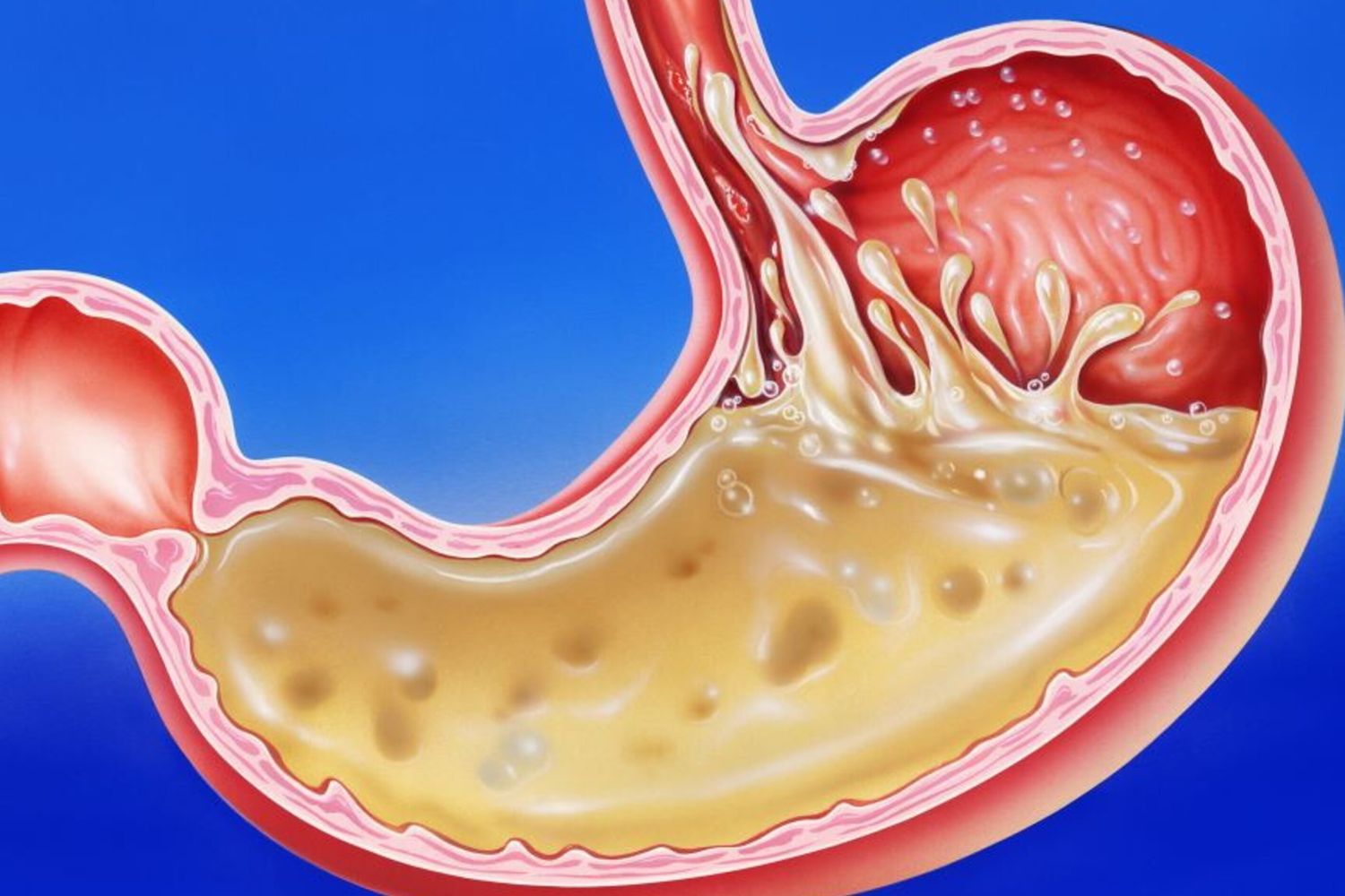 Reflusso gastroesofageo