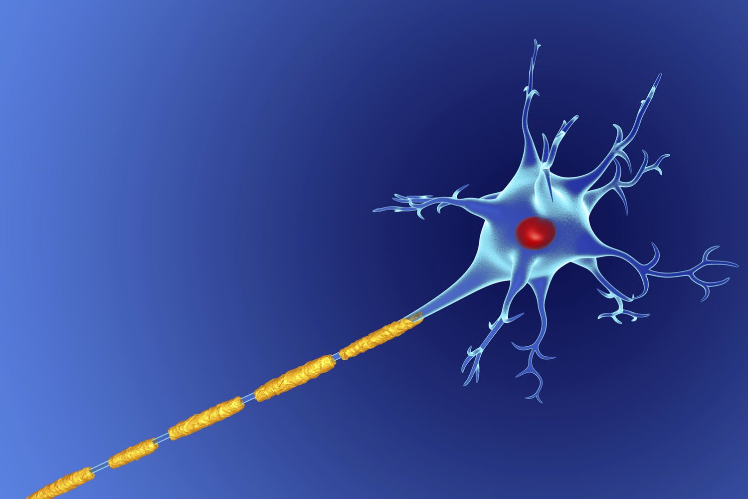 &nbsp;Sclerosi multipla