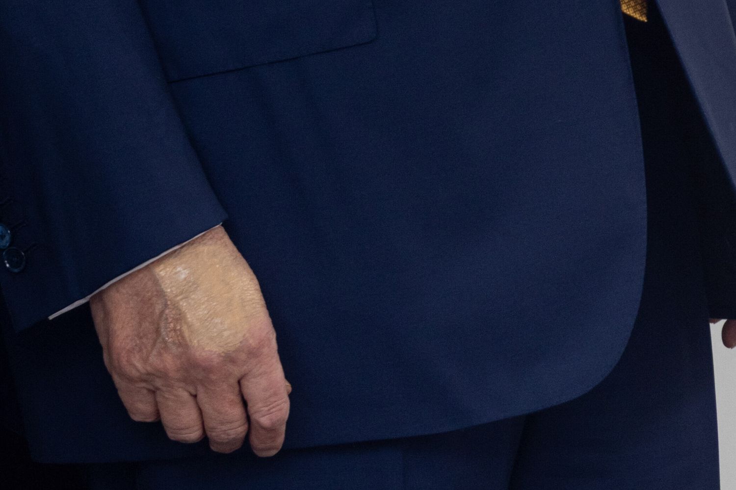 L'insufficienza venosa cronica di Donald Trump