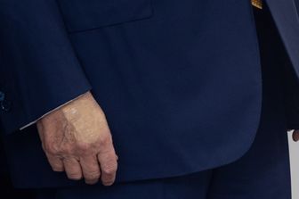 L'insufficienza venosa cronica di Donald Trump