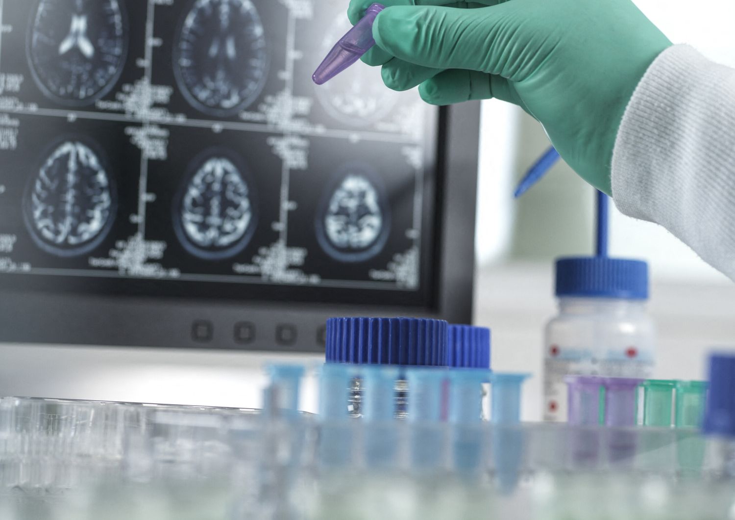 Demenza, studi sul comportamento del cervello