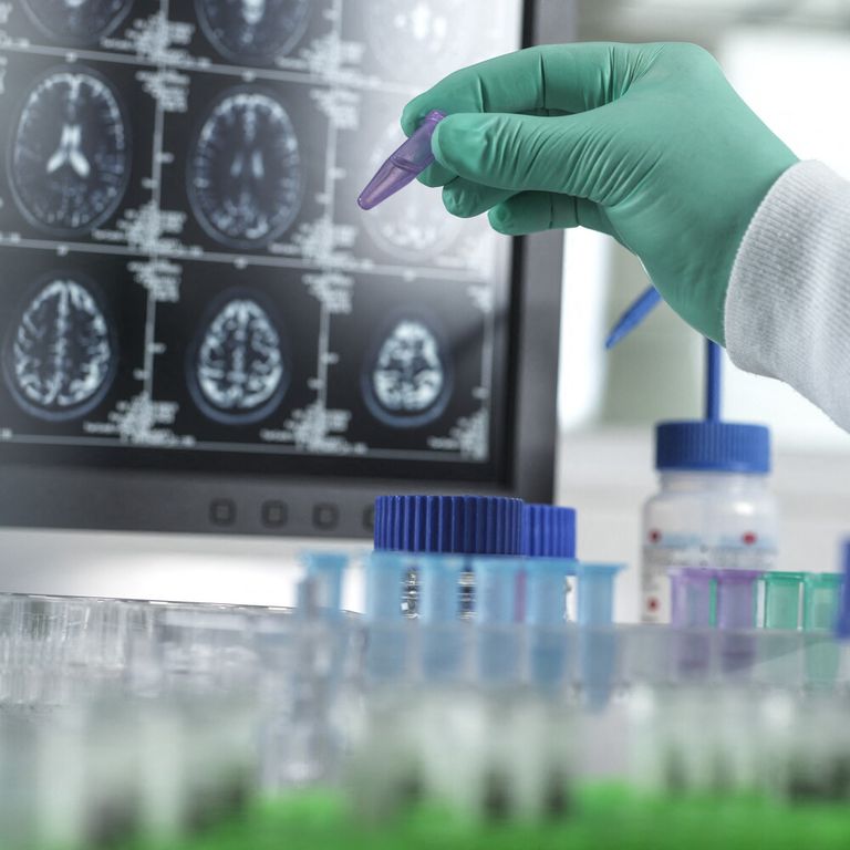 Demenza, studi sul comportamento del cervello