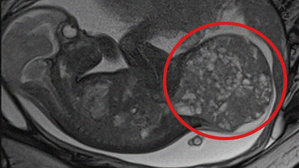 Salvata a Roma una neonata con un tumore da 800 grammi