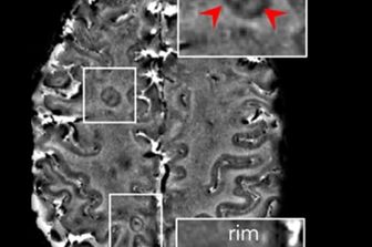 Immagine di un cervello ottenuta con risonanza magnetica in una persona affetta da sclerosi multipla. In dettaglio, indicate dalle frecce rosse, le lesioni croniche attive