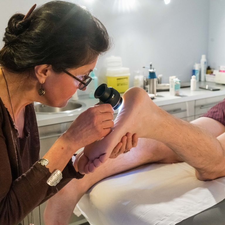 Melanoma, in 3 casi su 4 i più pericolosi sono i nei nuovi