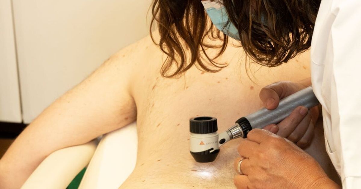 in 20 anni i casi di melanoma in italia sono pi249 che raddoppiati