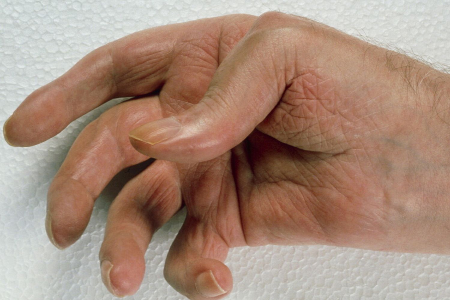 &nbsp;artrite reumatoide (Agf)