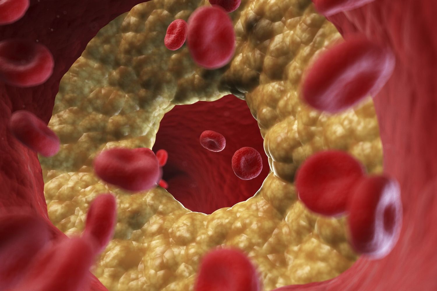 Colesterolo in arteria