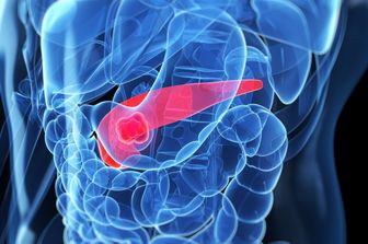 Tumori: +10% di pazienti vivi dopo una diagnosi di cancro al pancreas