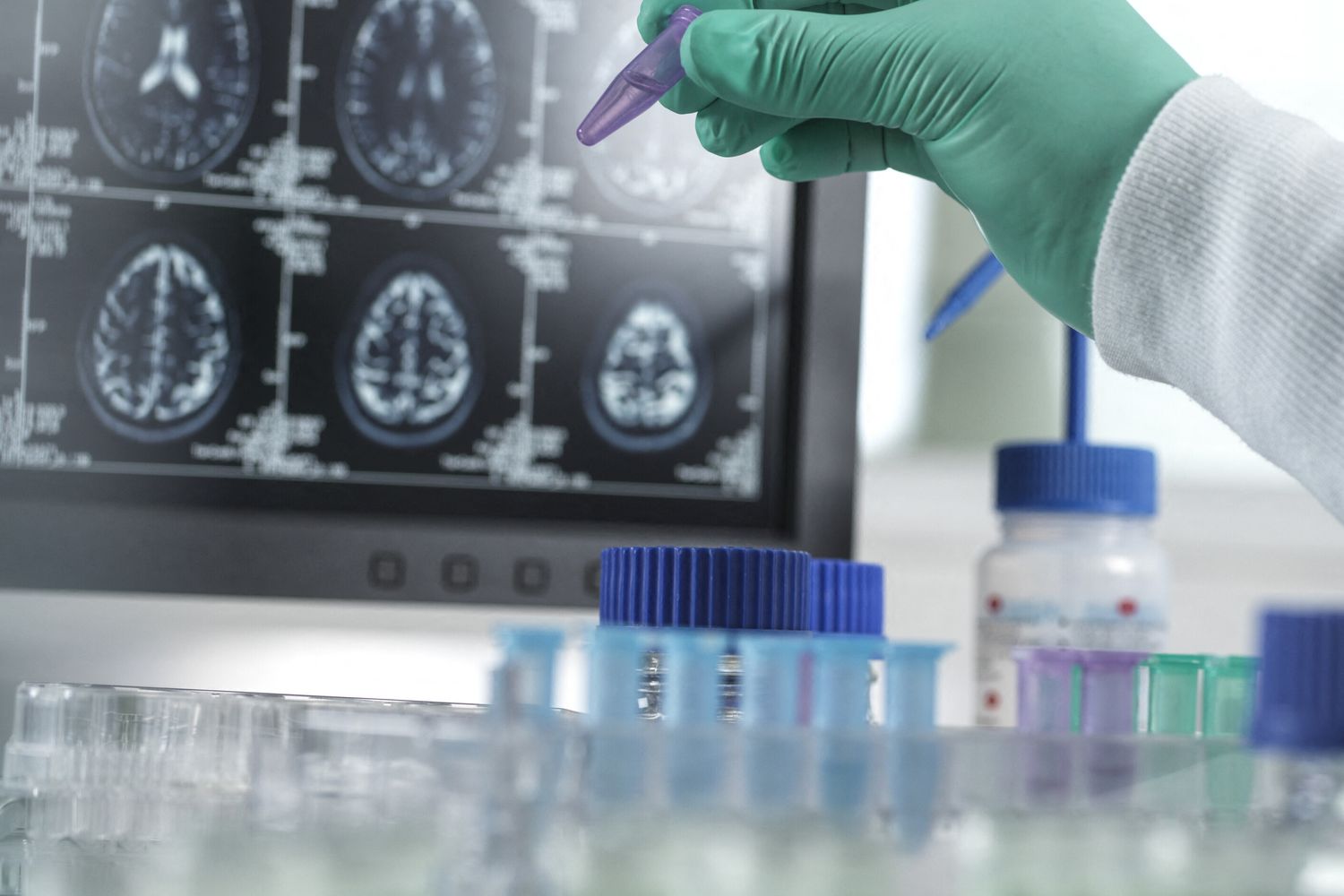 Demenza, studi sul comportamento del cervello