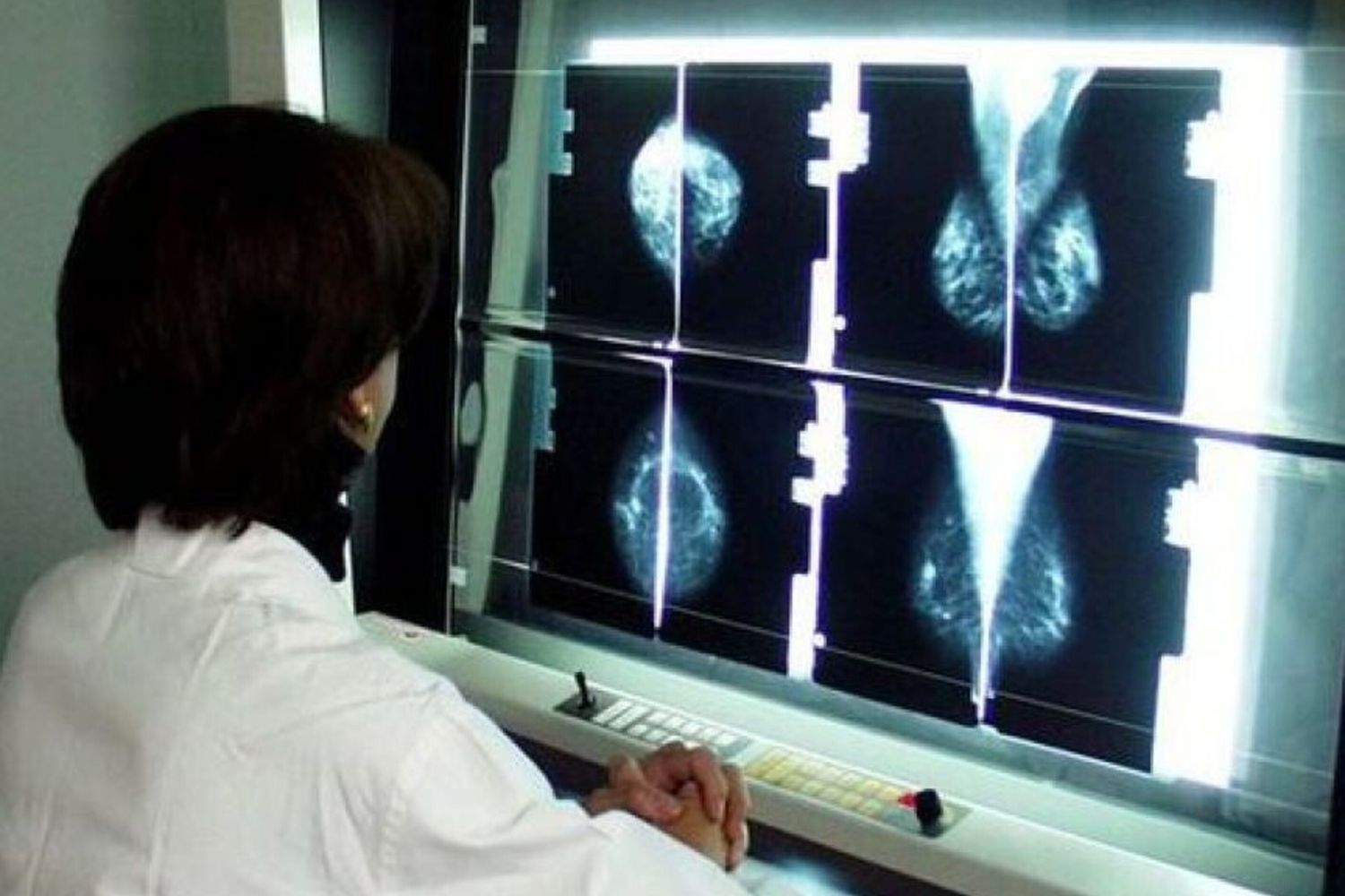 tumore cancro al seno lastre radiografie