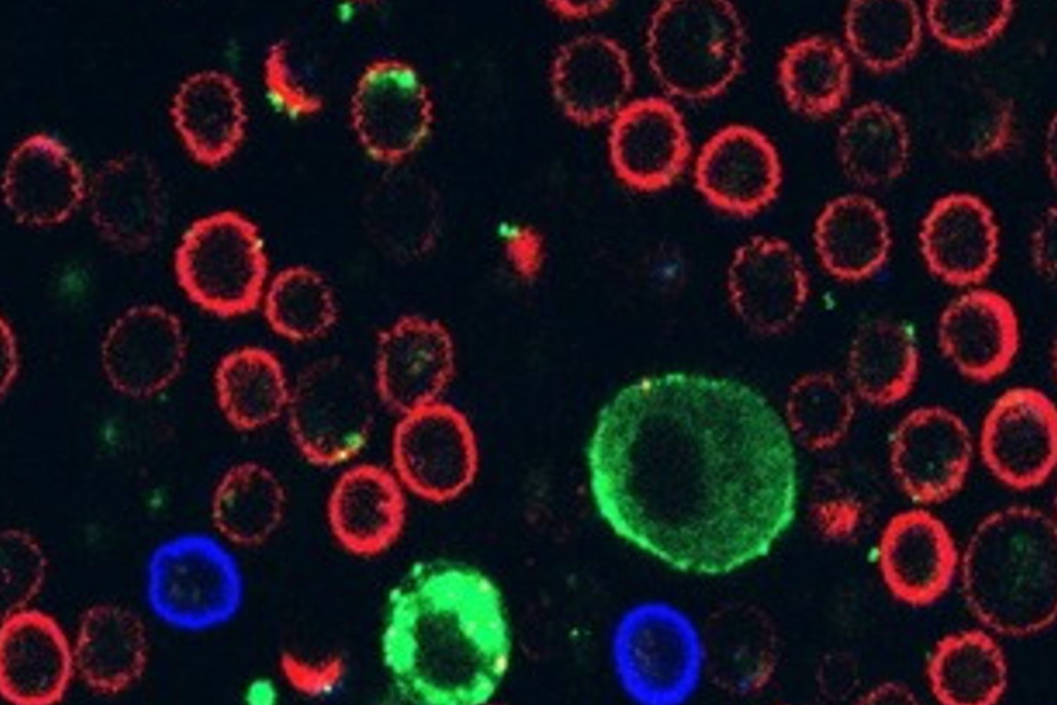 Melanoma, scoperto come paralizza i linfociti T