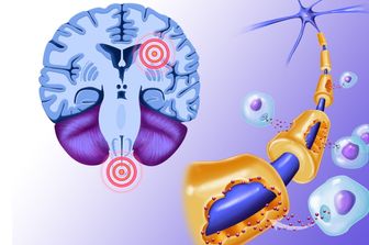 Sla scerosi multipla