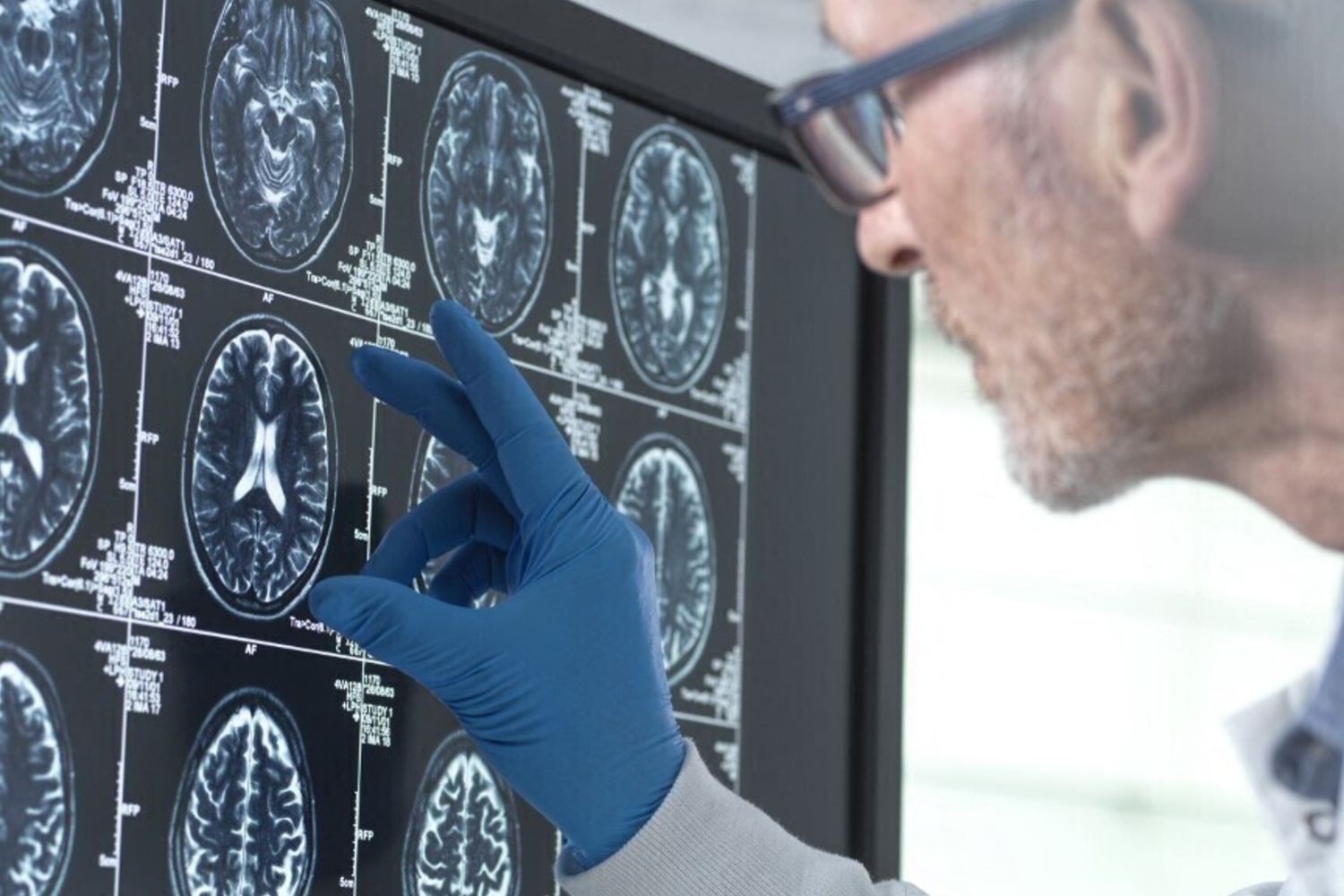 risonanza magnetica del cervello