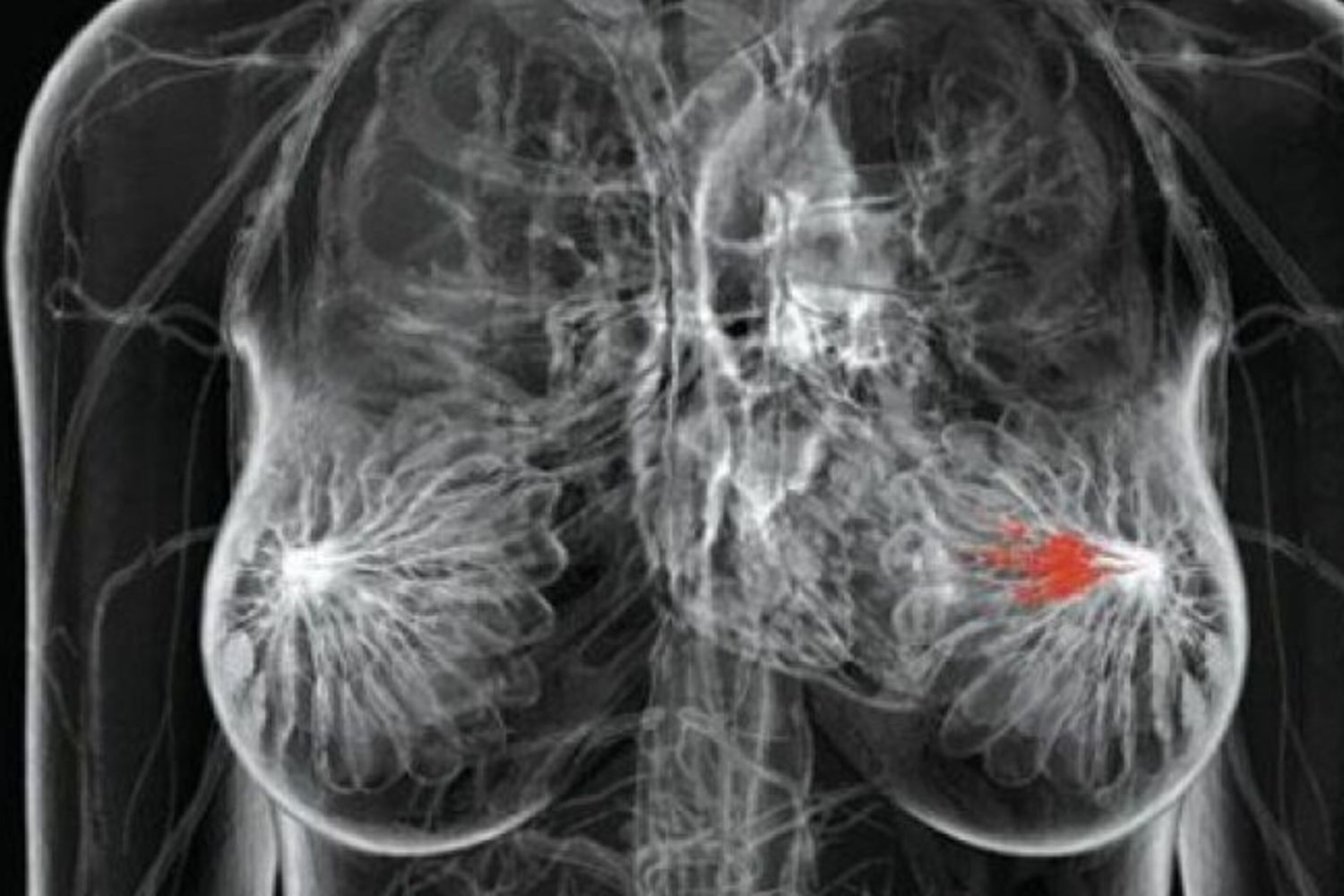 L'intelligenza artificiale migliora la rilevazione del cancro al seno