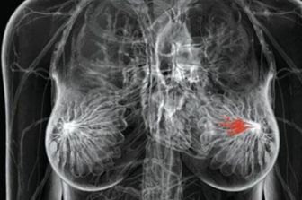 L'intelligenza artificiale migliora la rilevazione del cancro al seno