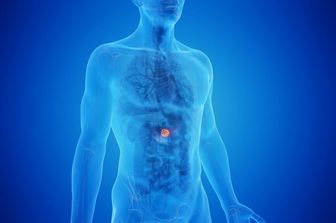 Tumore al pancreas