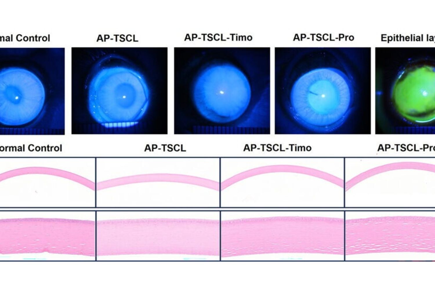 Contro il glaucoma arriva la lente a contatto “intelligente”
