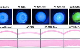 Contro il glaucoma arriva la lente a contatto “intelligente”