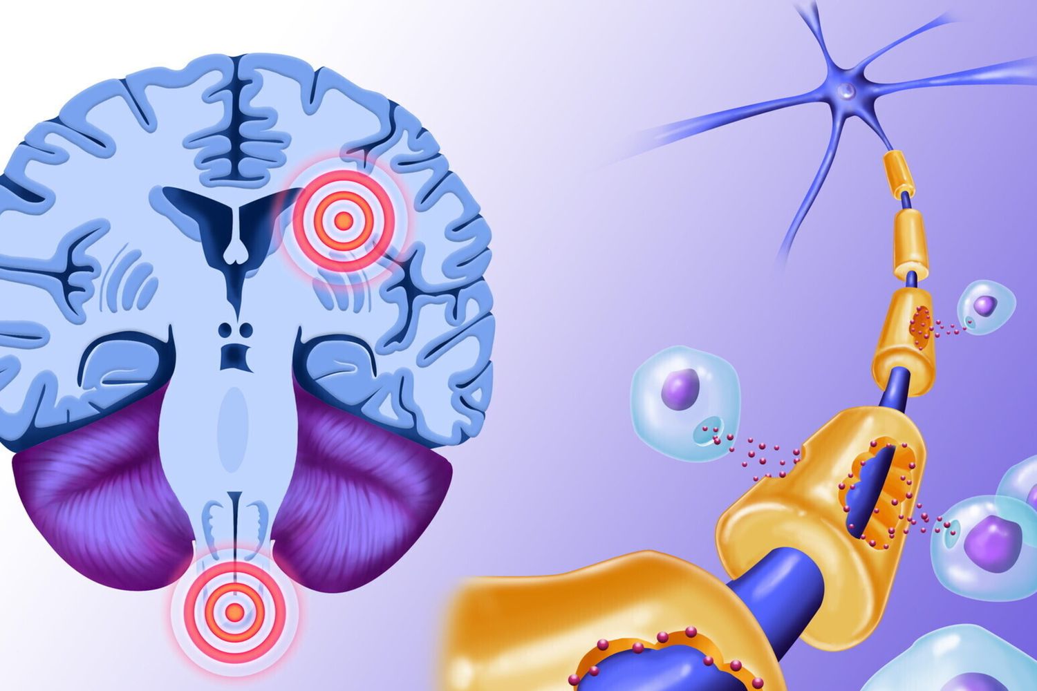 Sla scerosi multipla