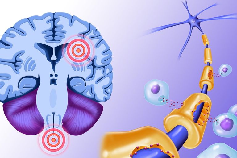 Sla scerosi multipla