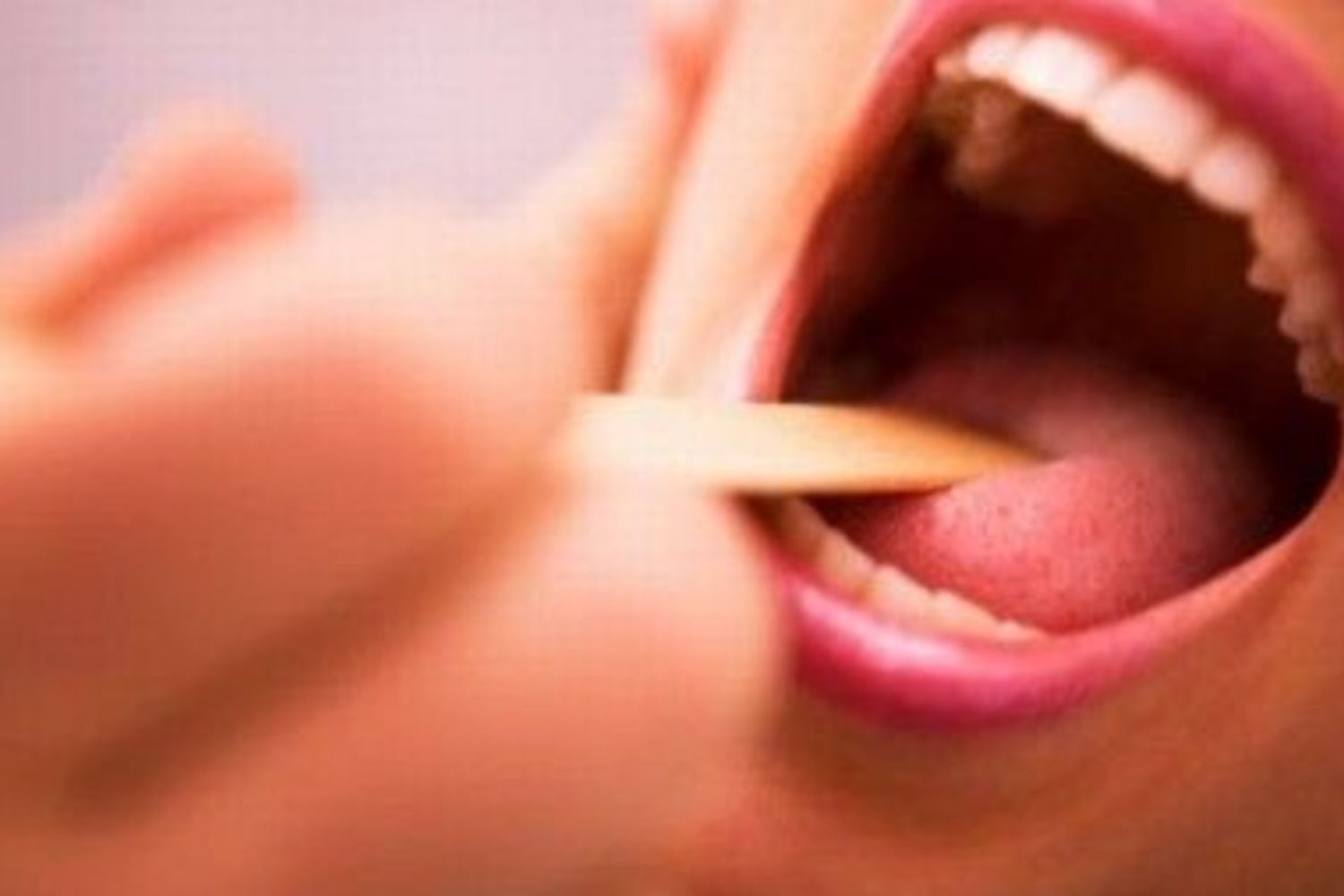 &nbsp;tonsille lingua