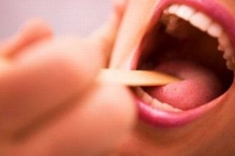 &nbsp;tonsille lingua