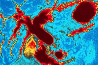 Colangiografia di un tumore al pancreas
