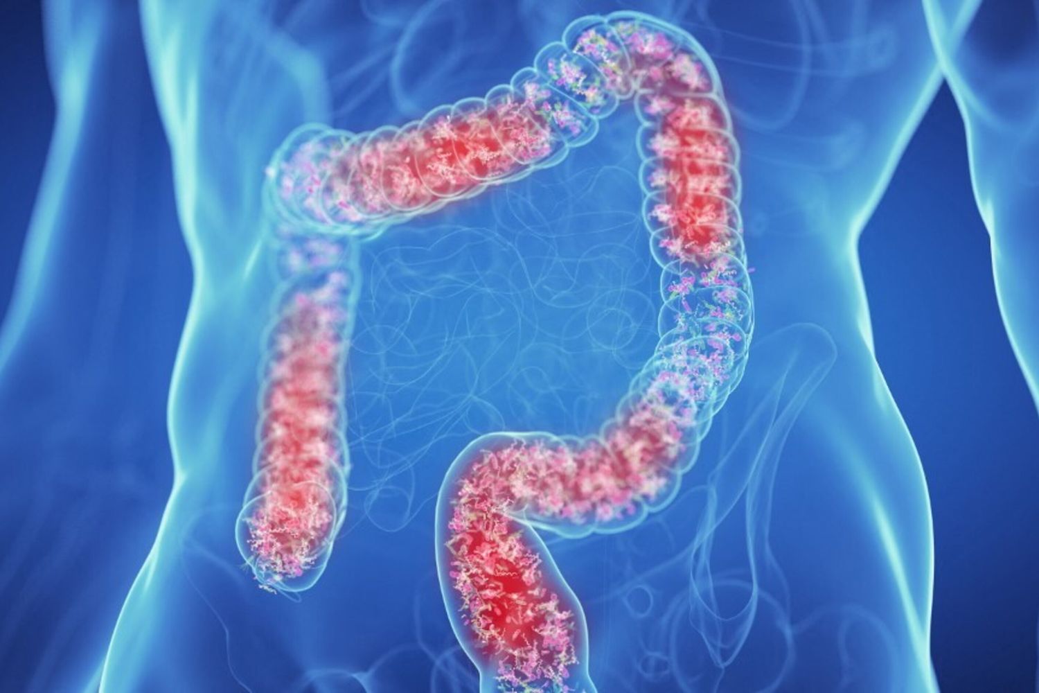 Colon irritabile