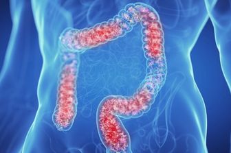 Colon irritabile